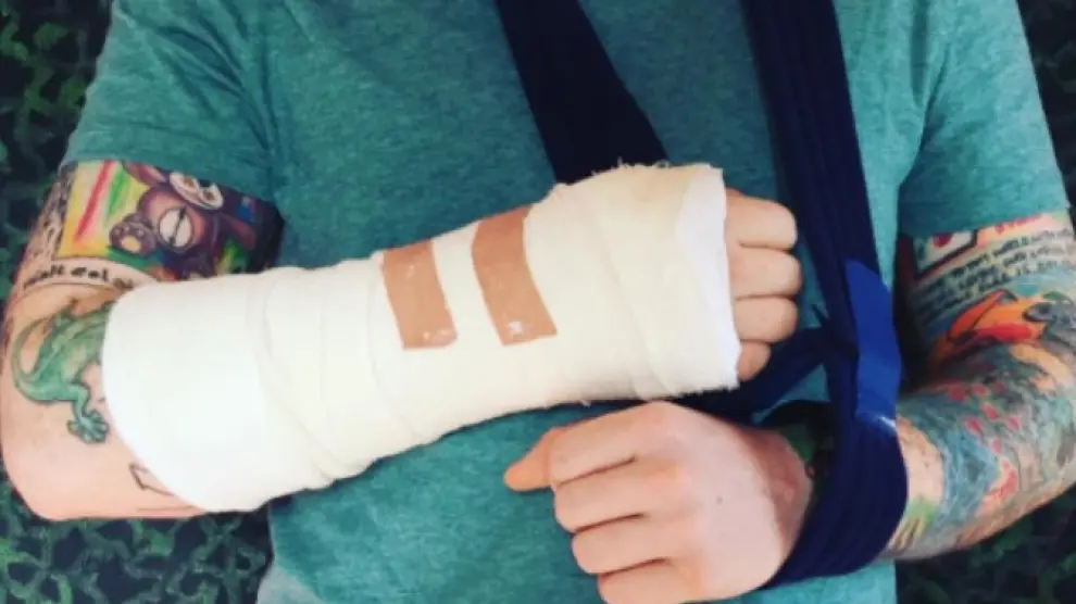 Ed Sheeran se fractura el brazo en un accidente de bici