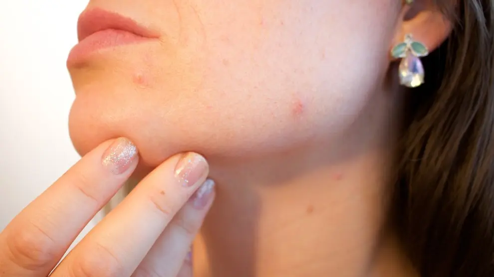 El acné afecta al 80% de los adolescentes hasta los 24 años y a mujeres con problemas hormonales.