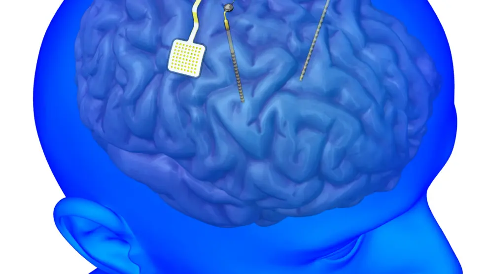 Los implantes cerebrales son dispositivos equipados con pequeños electrodos