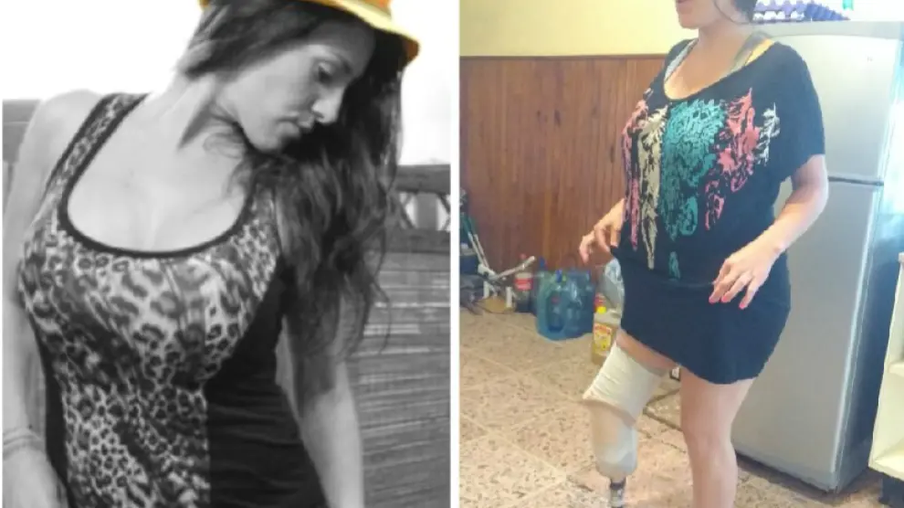 Mariela Ayala, a la izquierda, antes de someterse a la liposucción que le provocó la amputación de parte de la pierna derecha.