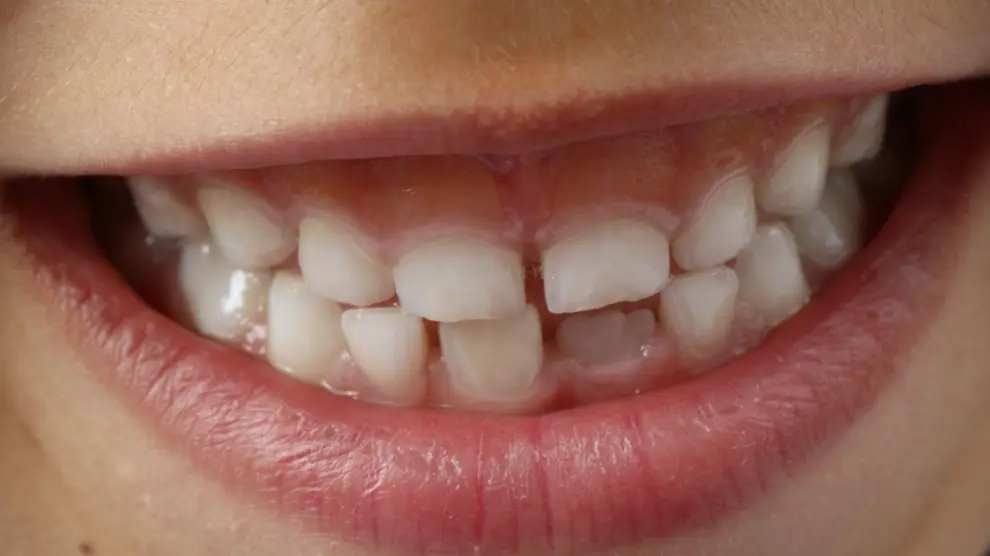 Los dientes definitivos comienzan a salir a los ocho años.