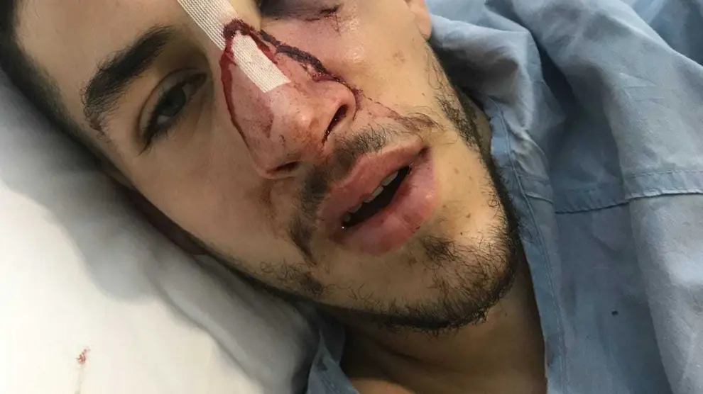 El jugador agredido tuvo que ser operado de una fractura facial y maxilar.