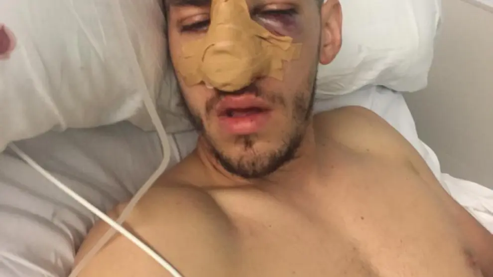 El jugador del Miralbueno lesionado tuvo que pasar por el quirófano al sufrir fractura facial y nasal.