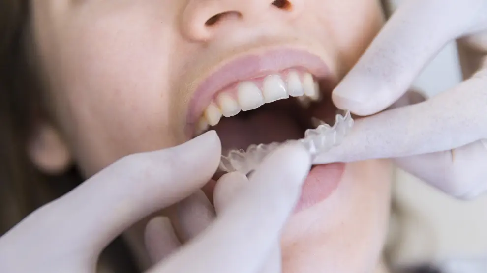 La ortodoncia transparente ha ganado popularidad en los últimos años y es igual de efectiva que la de 'brackets'.