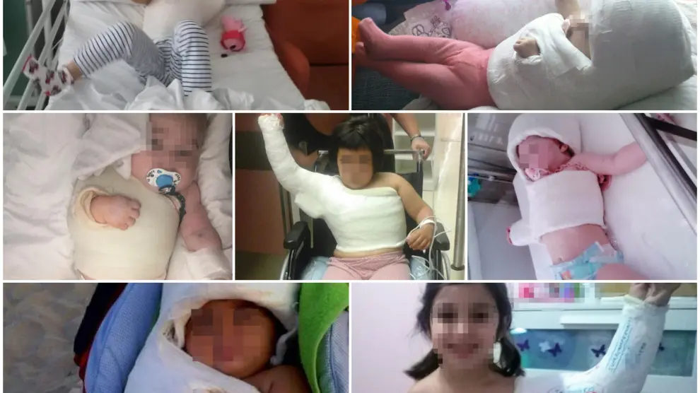 Varios niños con parálisis braquial obstétrica (PBO) que han sido derivados al Hospital San Juan de Dios de Barcelona.