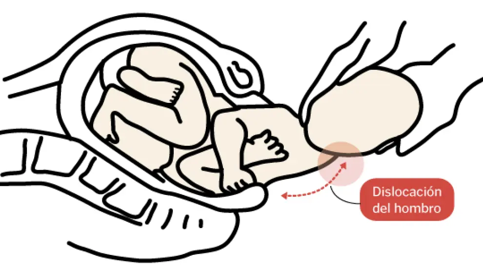 La parálisis braquial obstétrica es una lesión que se produce en el parto.