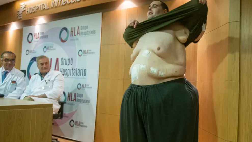Teo Rodríguez, un joven valenciano de 34 años con obesidad mórbida que llegó a pesar 385 kilos.