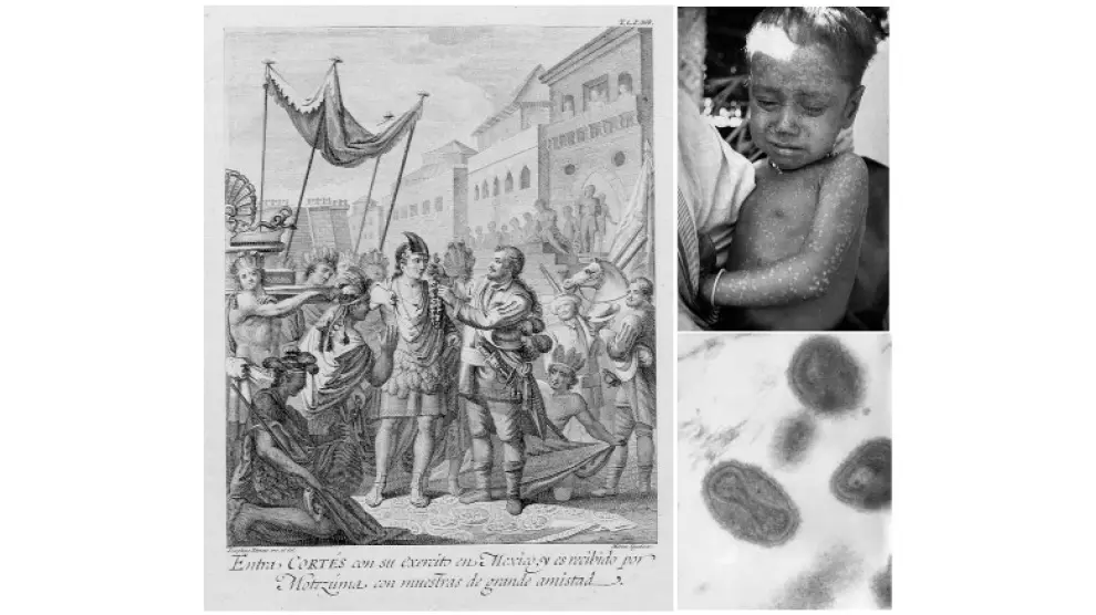 Grabado de Antonio de Solis y Rivadeneyra (1610-1686). Arriba a la derecha, niño infectado con el virus de la viruela. Debajo, virus de la viruela visto por microscopio electrónico