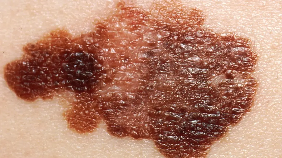 La genética y la exposición solar excesiva y repetitiva son factores que inciden en el desarrollo del melanoma, un tipo de cáncer de piel.