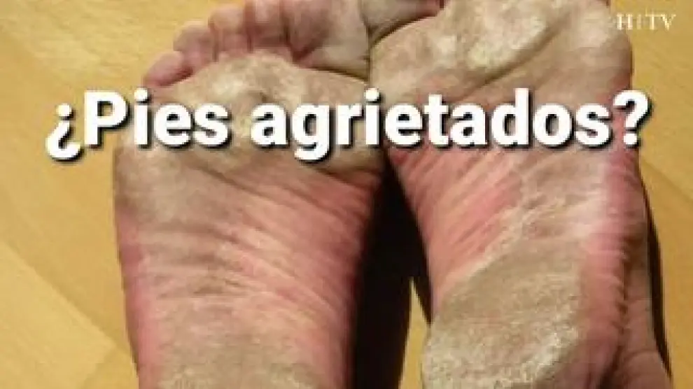 Eduardo Sanz Lagunas, presidente de la Asociación de Herbolarios y Ecotiendas de Zaragoza, recomienda exfoliarlos primero para luego aplicar diferentes remedios naturales con el fin de acabar con la sequedad de los pies, tan común en verano.