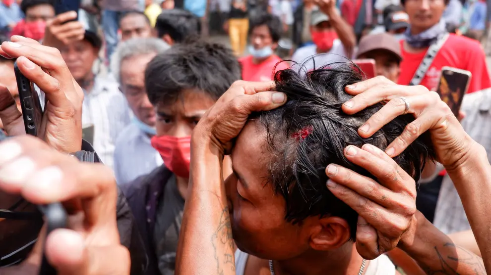 A man shows an injury after the police fired rubber bullets during protests against the military coup, in Mandalay