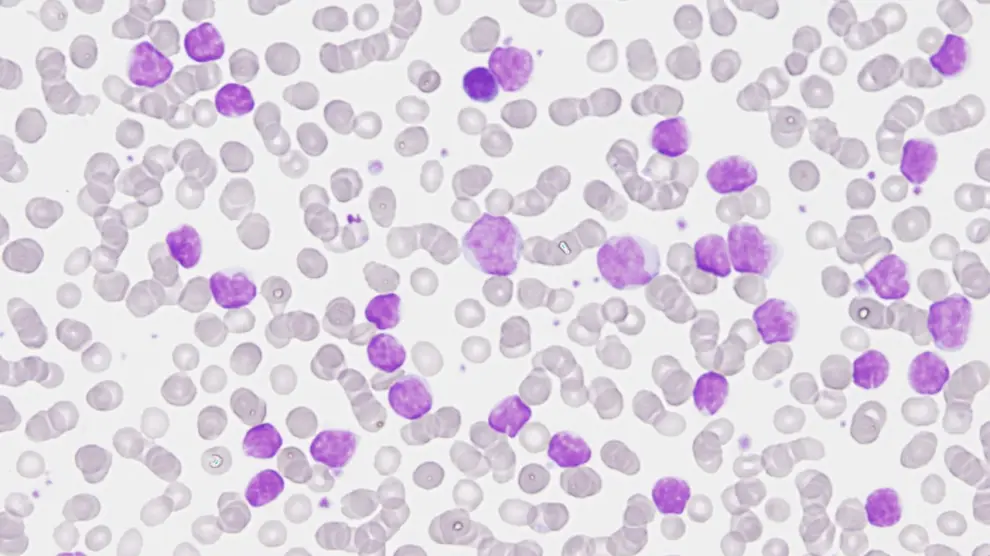 Imagen de una citología de leucemia linfática crónica.