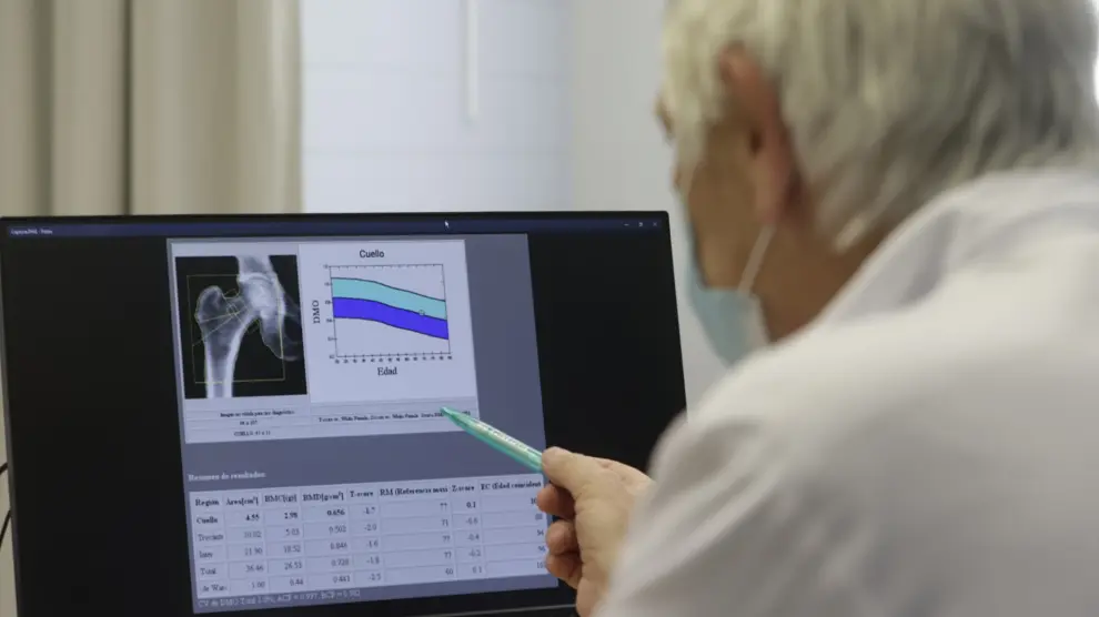 El doctor Chesus Beltrán, reumatólogo del Servet, muestra la radiografía de un paciente con osteoporosis.