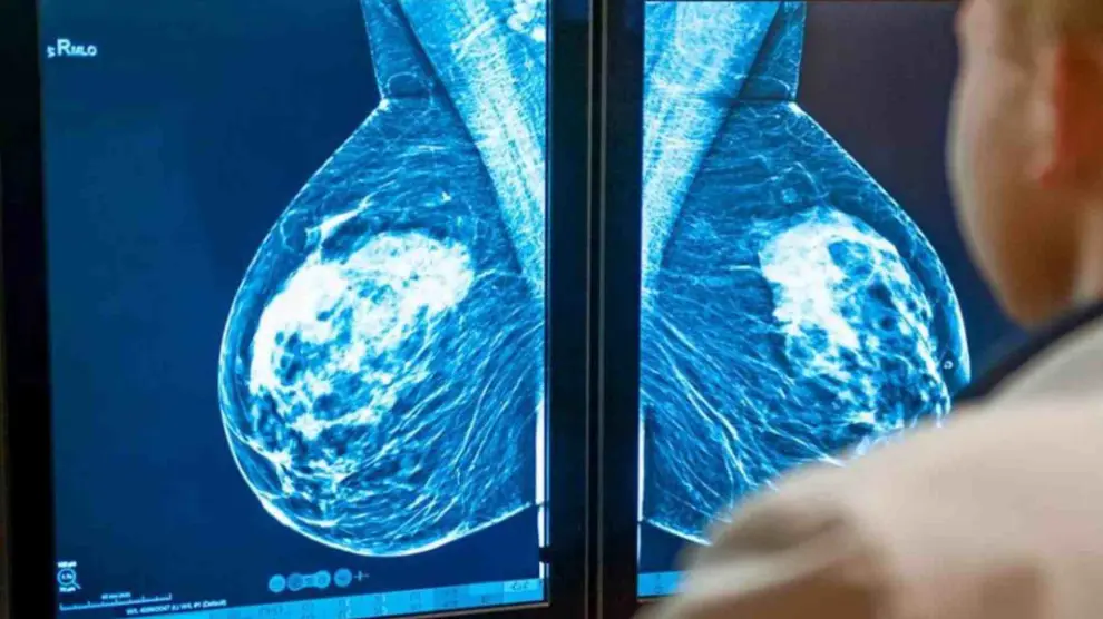 Imagen de una mama afectada por un tumor