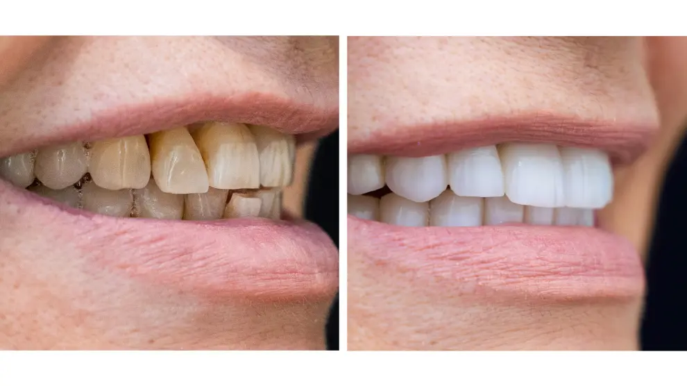 Las carillas de cerámica se fusionan al diente simulando una dentadura más joven y perfecta.