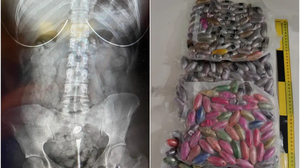 Combo de imágenes de una radiografía mostrando una bellota en el estómago y del total de droga incautada
