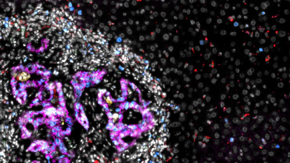 Metástasis de cáncer colorrectal (mitad izquierda de la imagen) en el hígado.