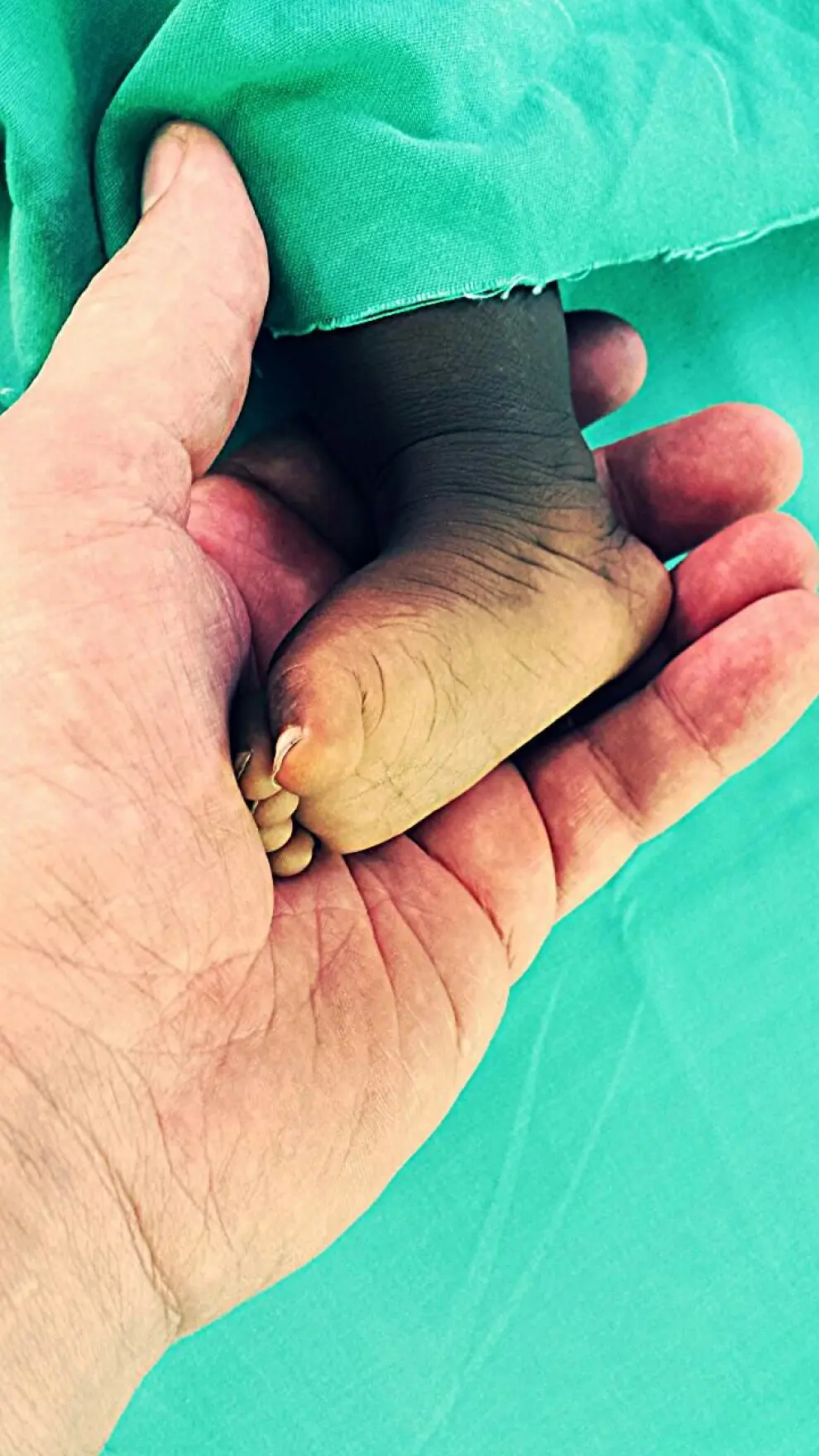 África y Europa colaborando juntas contra la hidrocefalia. En la imagen, el autor del documental 'Un hospital en África' sostiene en su mano el pie de una niña.