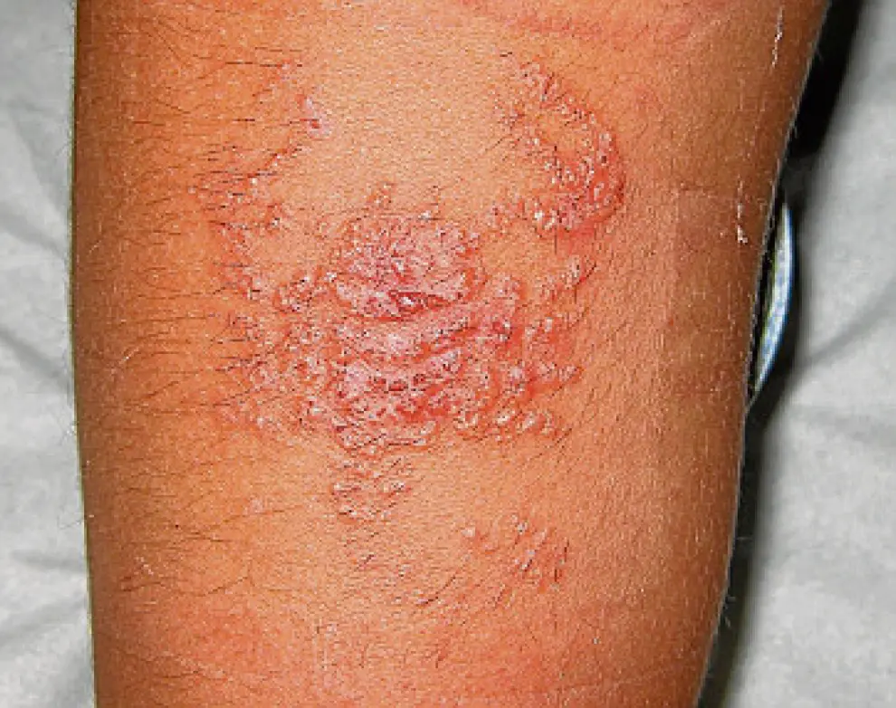 Otro de los menores tratados en un centro de salud desarrolló una dermatitis tras tatuarse con henna negra un escorpión. En la foto se aprecia la marca después de unos días.