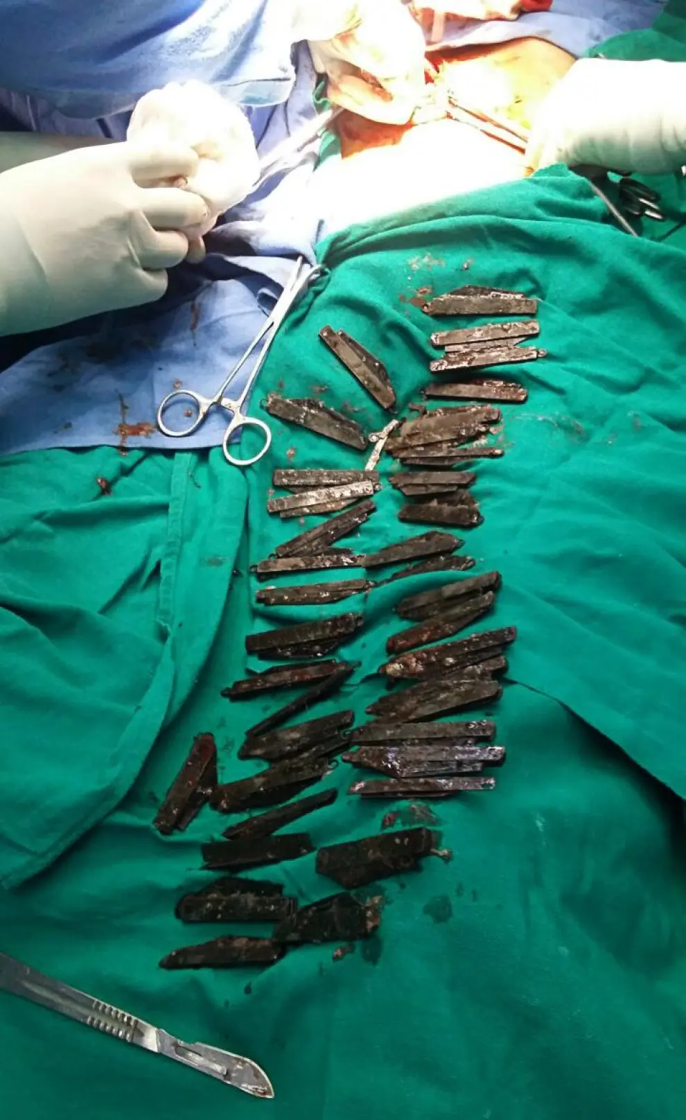 Cirujanos indios extraen 40 cuchillos del estómago e intestino de un paciente