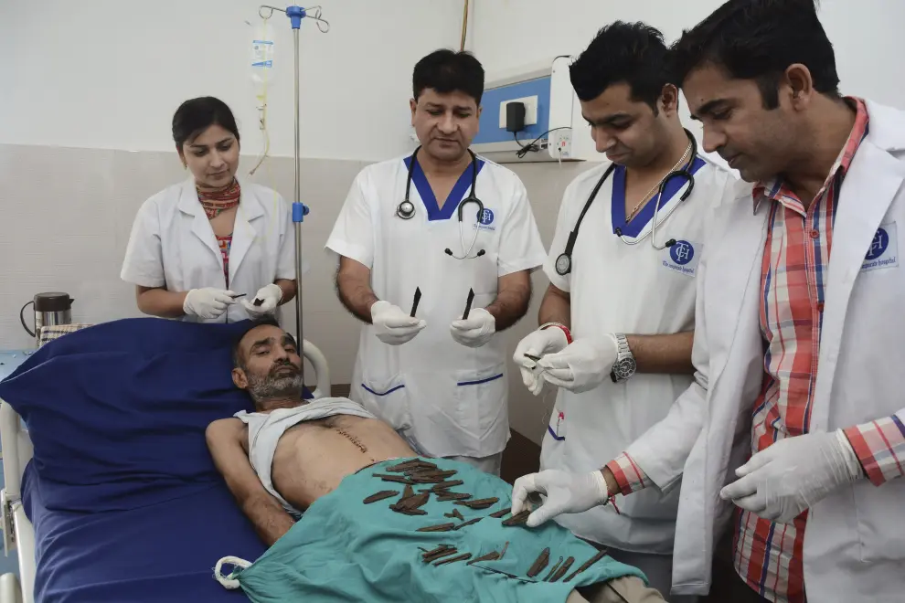 Cirujanos indios extraen 40 cuchillos del estómago e intestino de un paciente