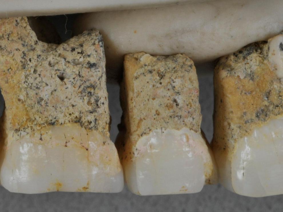 Dientes superiores de la nueva especie humana hallada en Filipinas.
