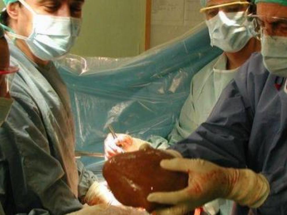 Trasplante hepático realizado en el Hospital Clínico de Zaragoza.