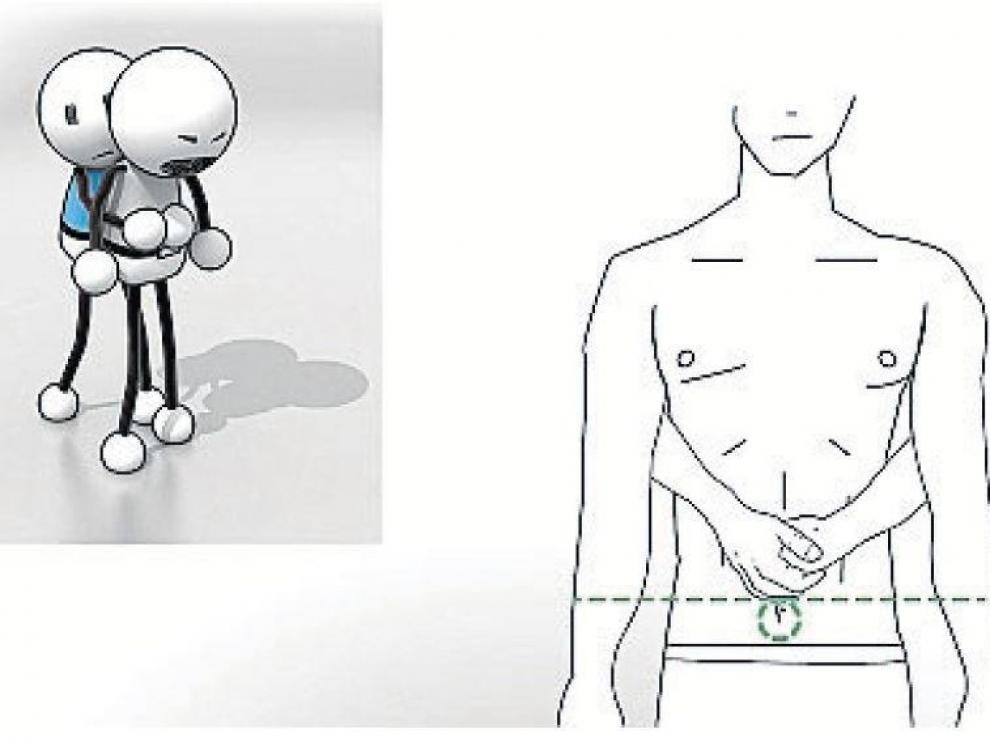 Maniobra de Heimlich
