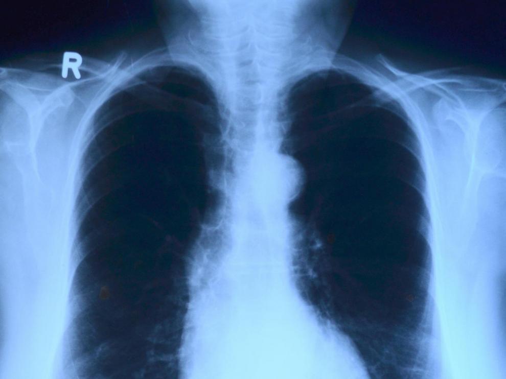Radiografía de torax.