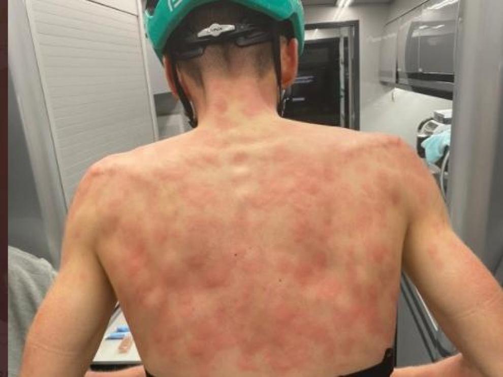Así quedó la espalda del ciclista Máxime Chevalier.