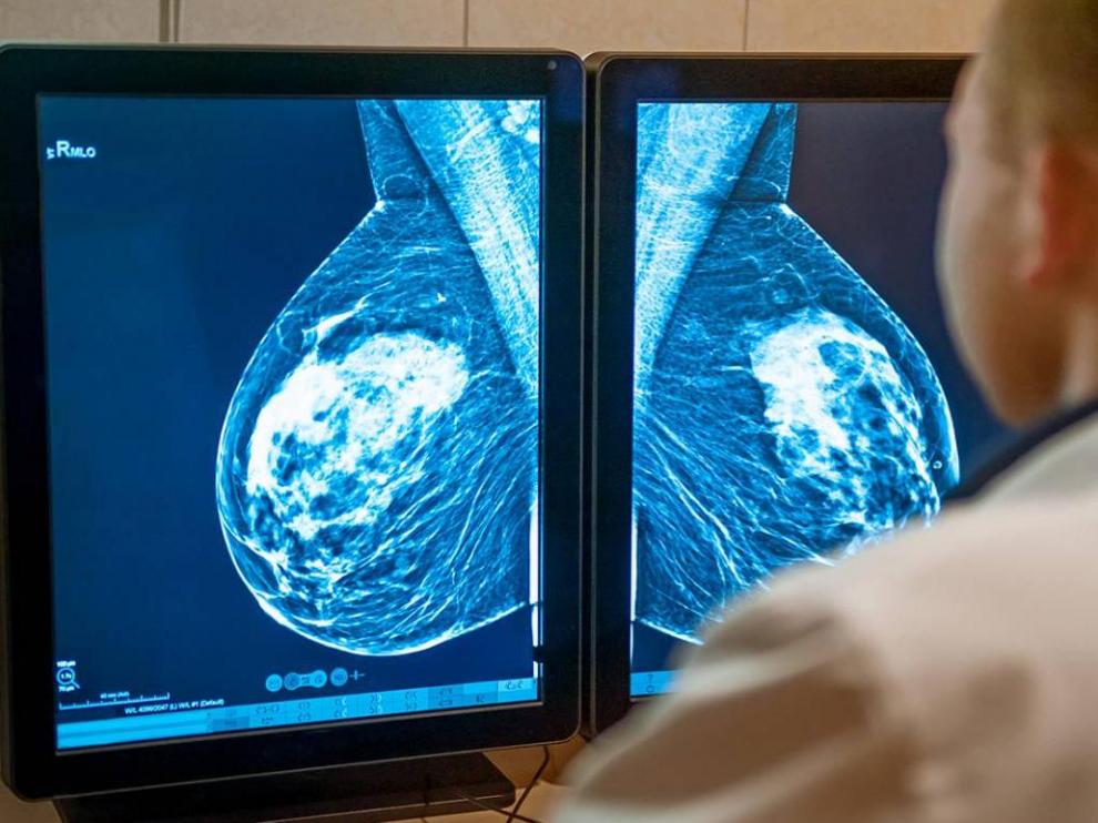 Los resultados del nuevo estudio cambian la práctica clínica en el cáncer de mama más frecuente y evitará la quimioterapia a miles de pacientes.