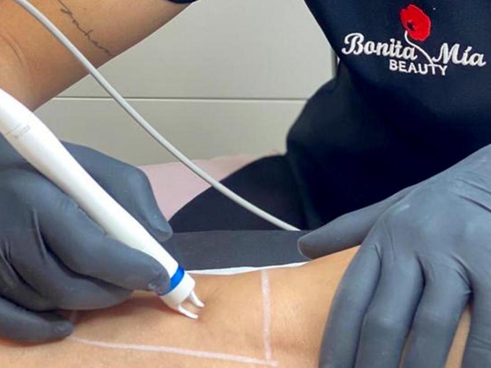 Tratamiento con láser para la desaparición de arañas vasculares.