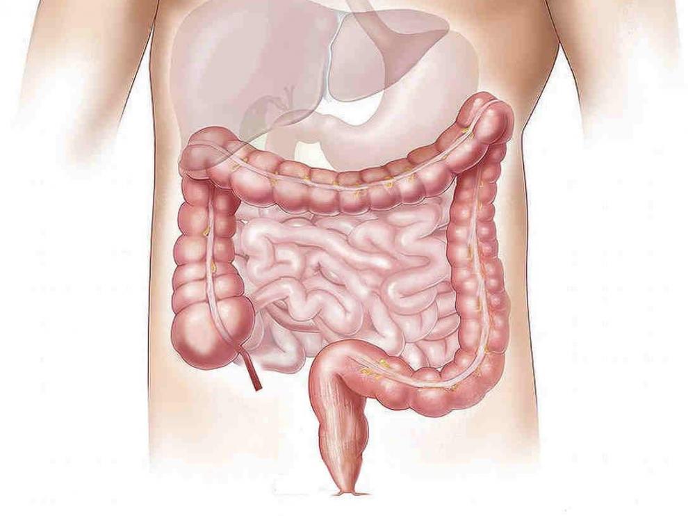 Cáncer de colon.