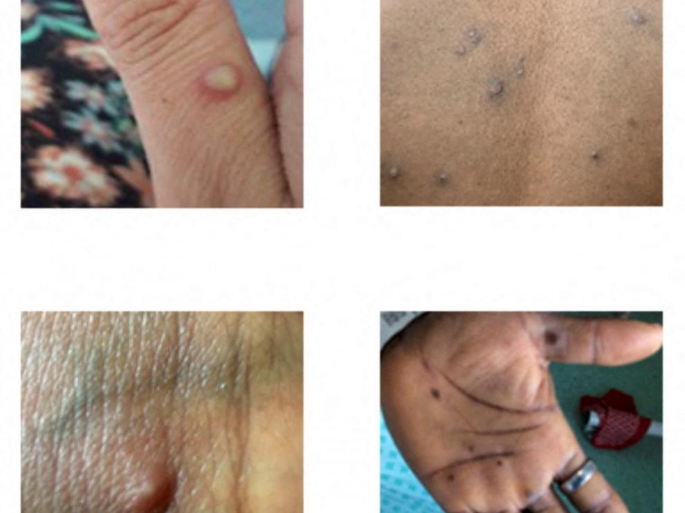 Ejemplos de las lesiones producidas por la viruela del mono