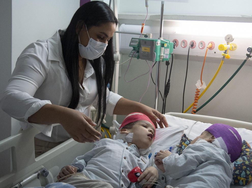 Más de 30 horas de operación para separar a dos siameses unidos por el