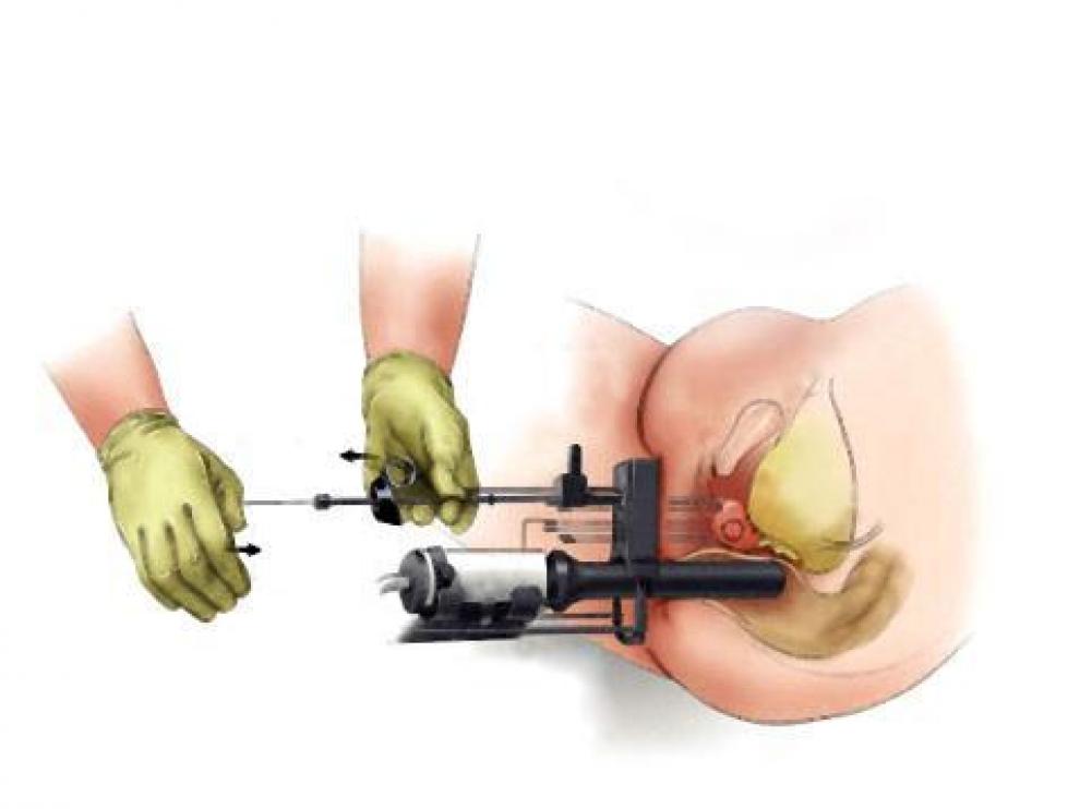 El Servet pondrá también en marcha una técnica poco invasiva para el cáncer de próstata