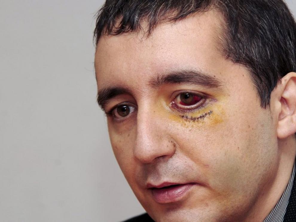 Pedro Alberto Cruz todavía tiene signos visibles de la paliza