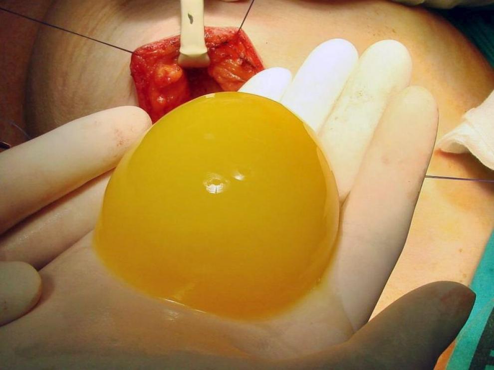 El gel sirve para restituir el volumen de una mama tras la extracción de un tumor