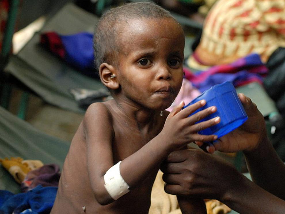 Un niño es atendido por sus problemas de salud en Somalia