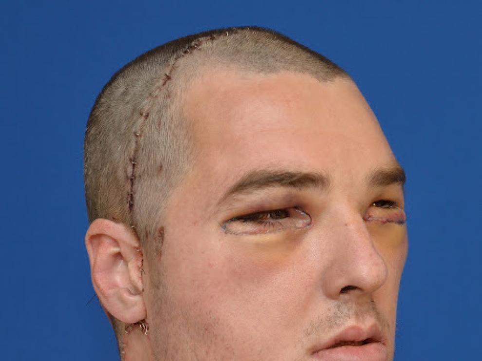 Richard Lee Norris, tras el transplante