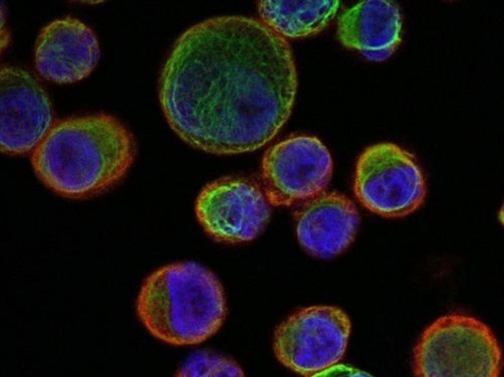 La sobreexpresión del canal de sodio 'Nav.16' puede usarse como marcador molecular y como blanco terapéutico.