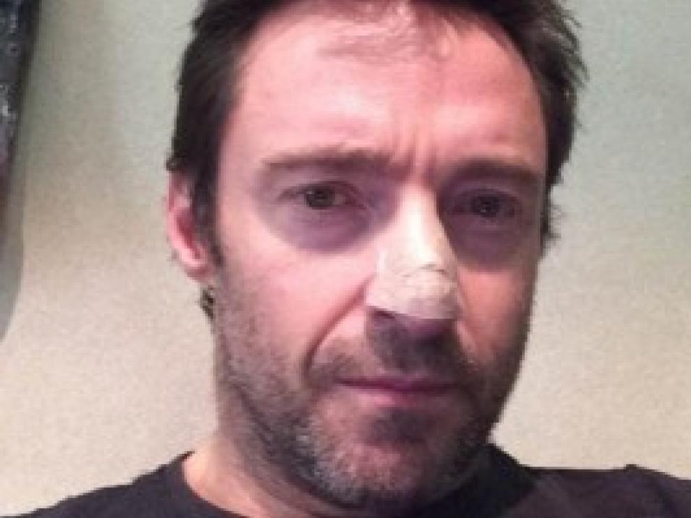 Jackman mostrando su carcinoma