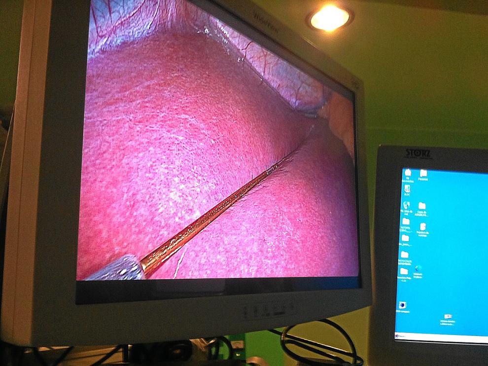 Imagen, durante una intervención de laparoscopia, en la que se observa un electrodo sobre el hígado para medir su gracia
