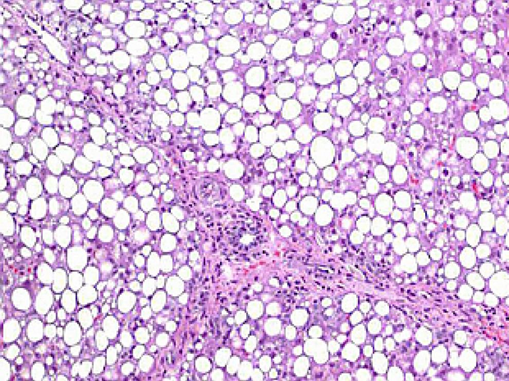 Imagen de un hígado graso de un paciente obeso con una infiltración grasa de las células hepáticas (hepatocitos) en una proporción del 70%