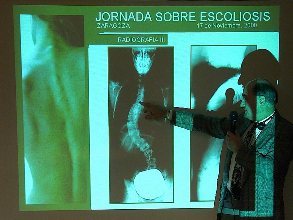 El 4% de los niños padece escoliosis no diagnosticada