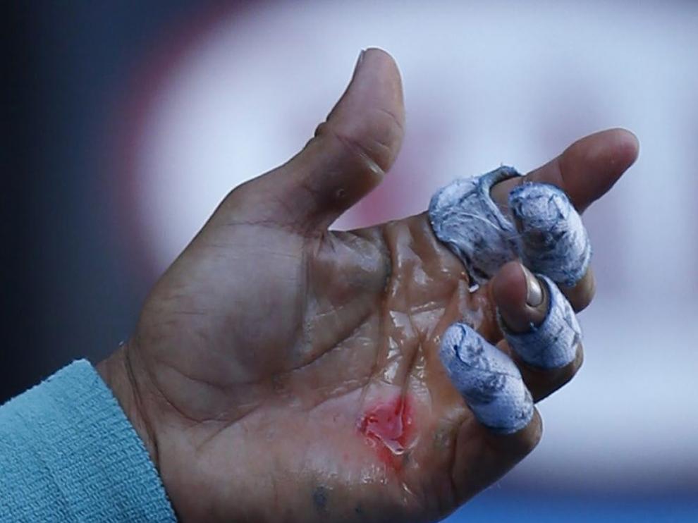 Herida de Rafa Nadal en la mano