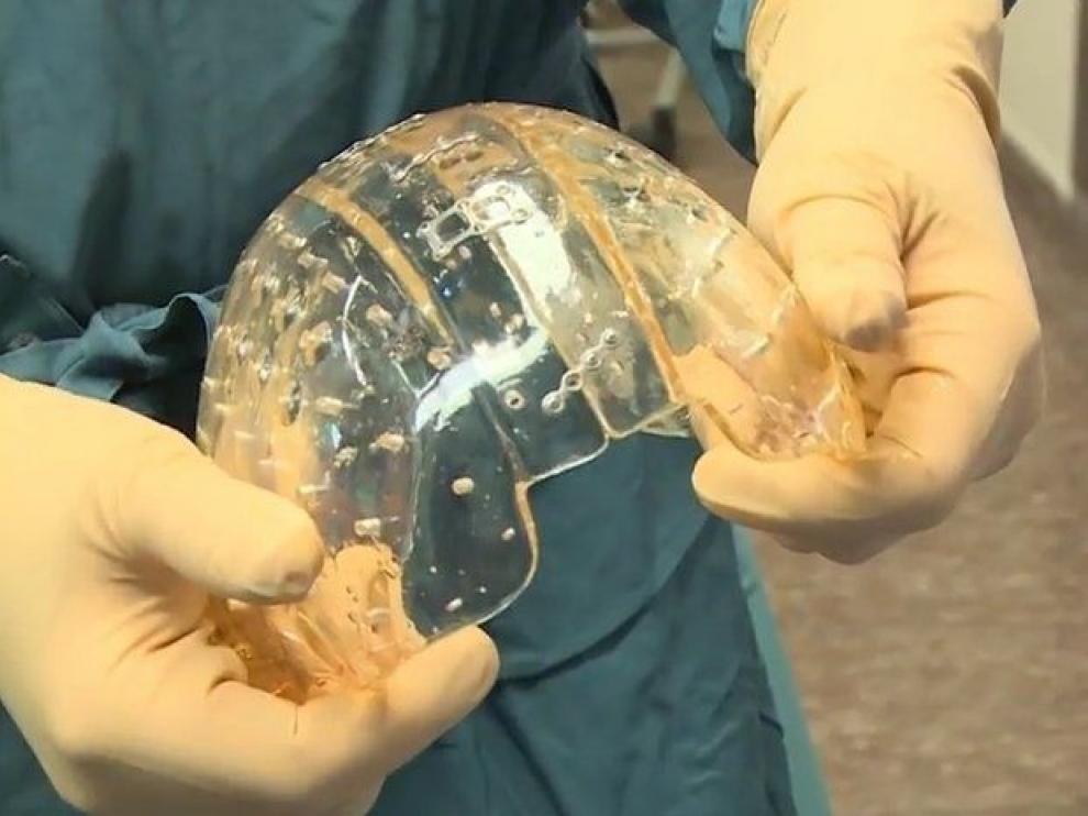 Imagen del cráneo de plástico implantado.