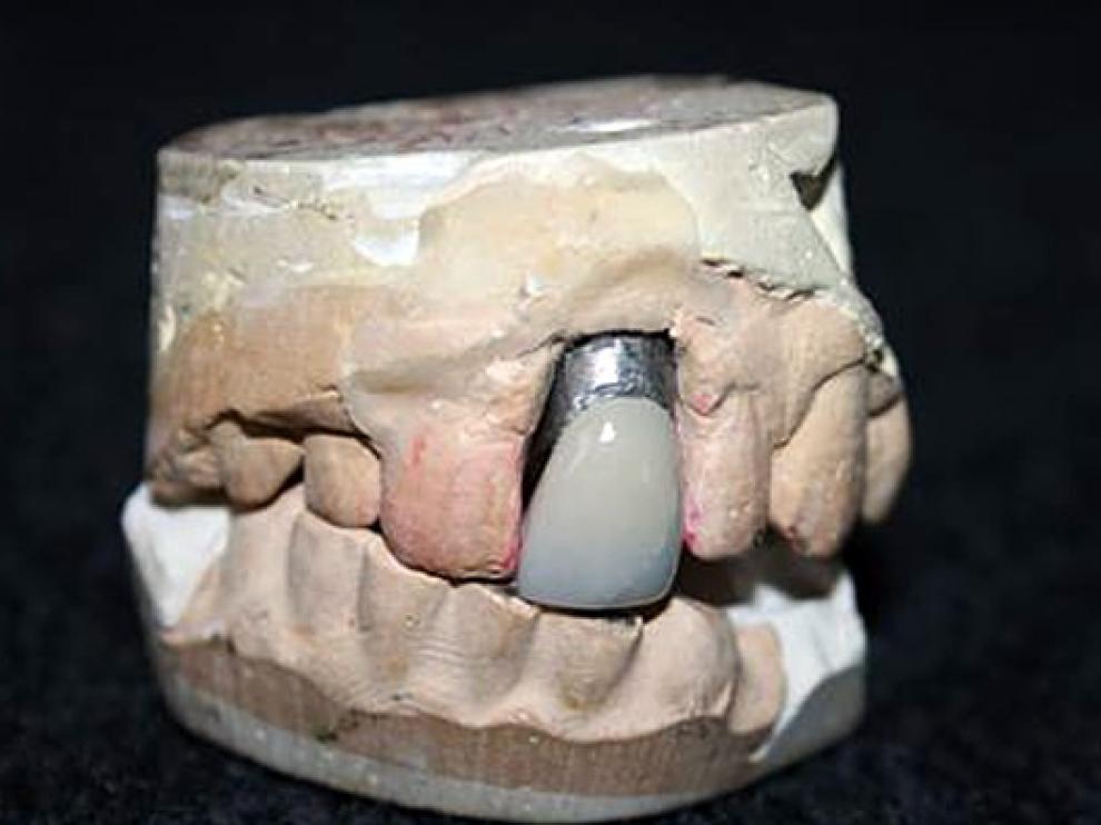La dentadura de Elvis Presley, método para concienciar sobre el cáncer de boca