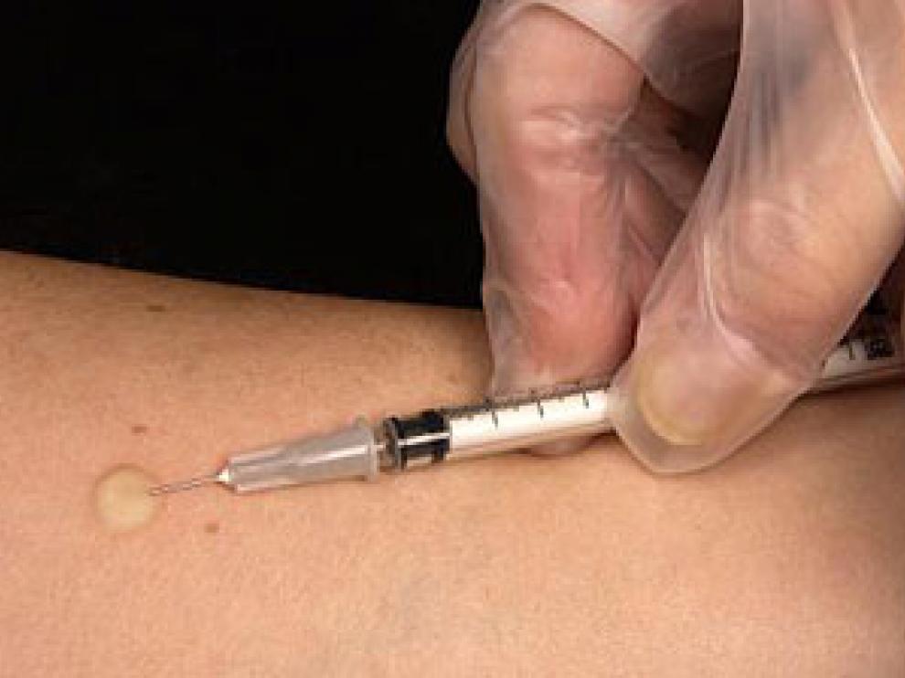 La prueba de la Tuberculina es la técnica habitual en la detección de la tuberculosis.