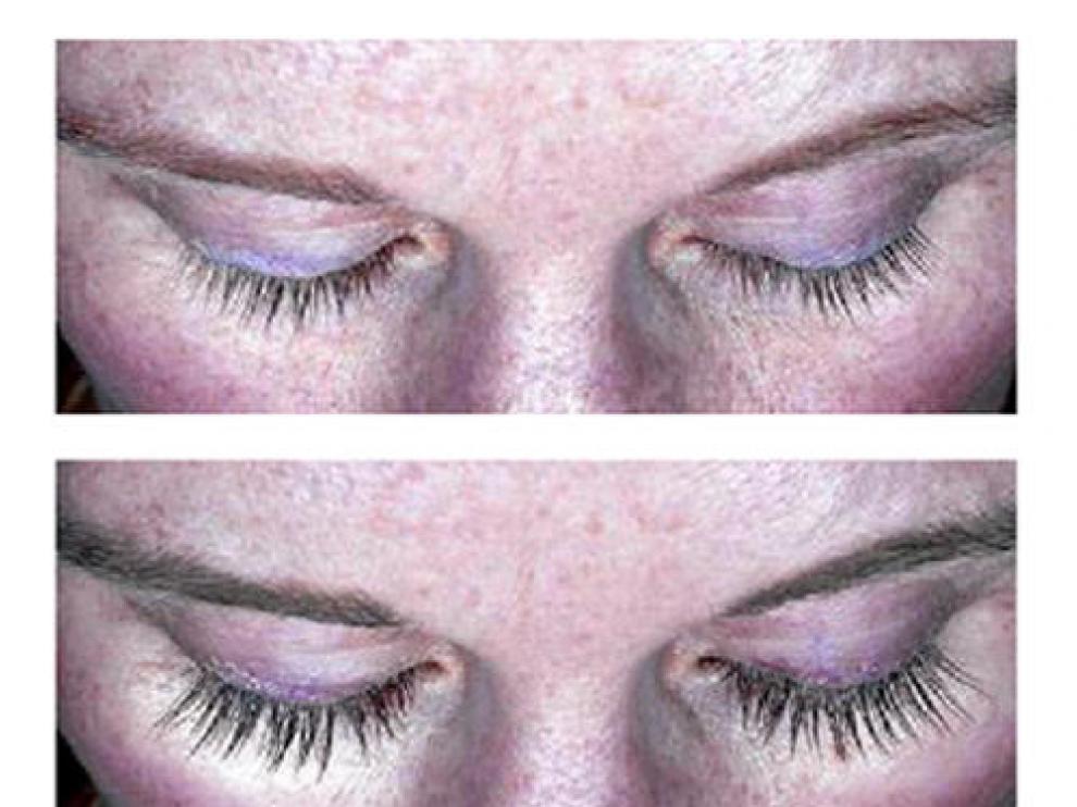 Antes y después del botox